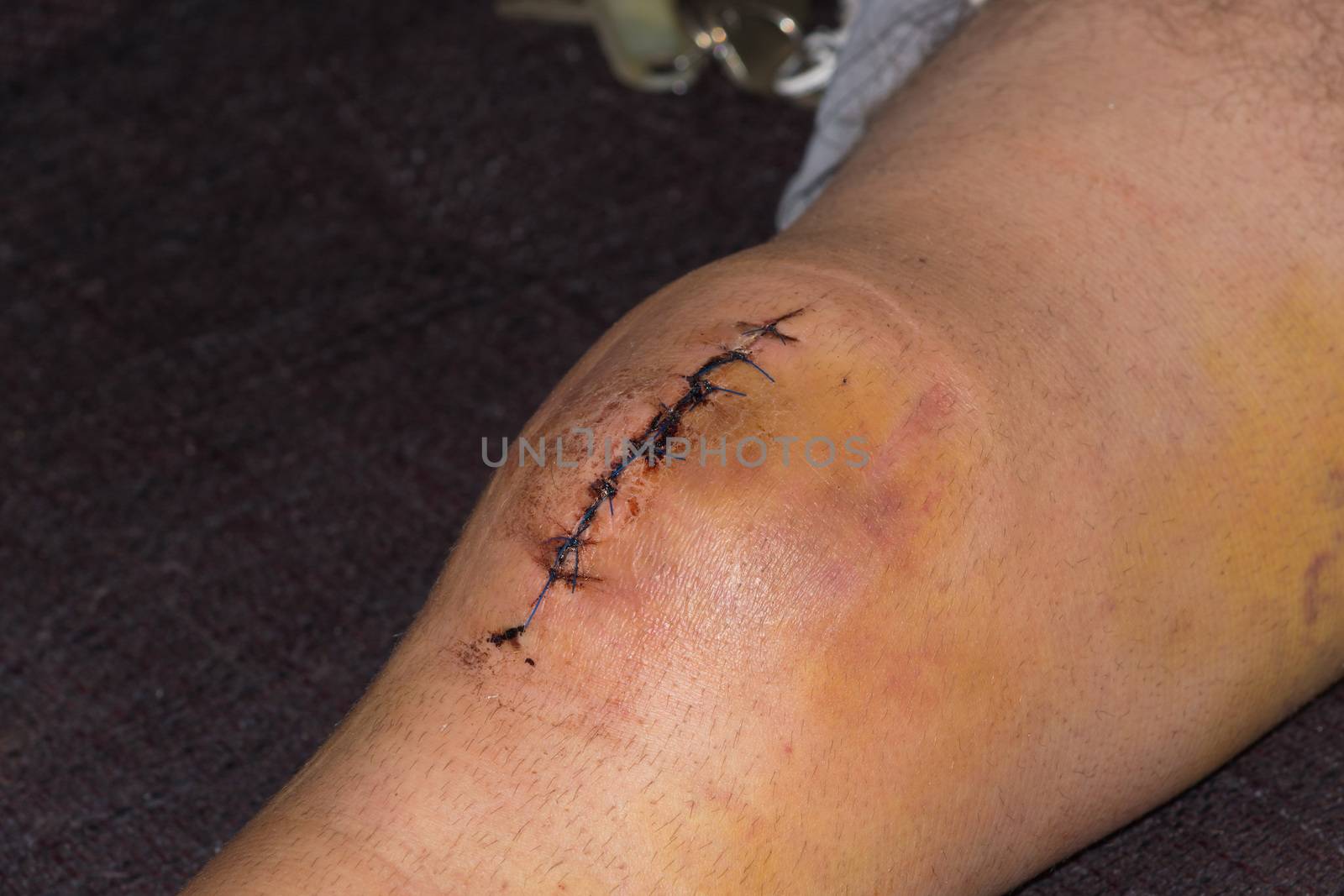 Male knee after surgical operation, knee replacement. Knee surgery in the hospital