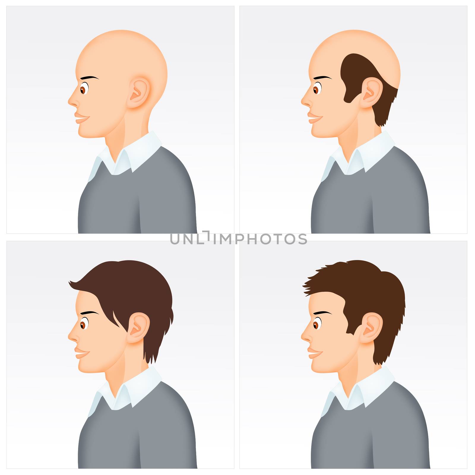 illustration of baldness man