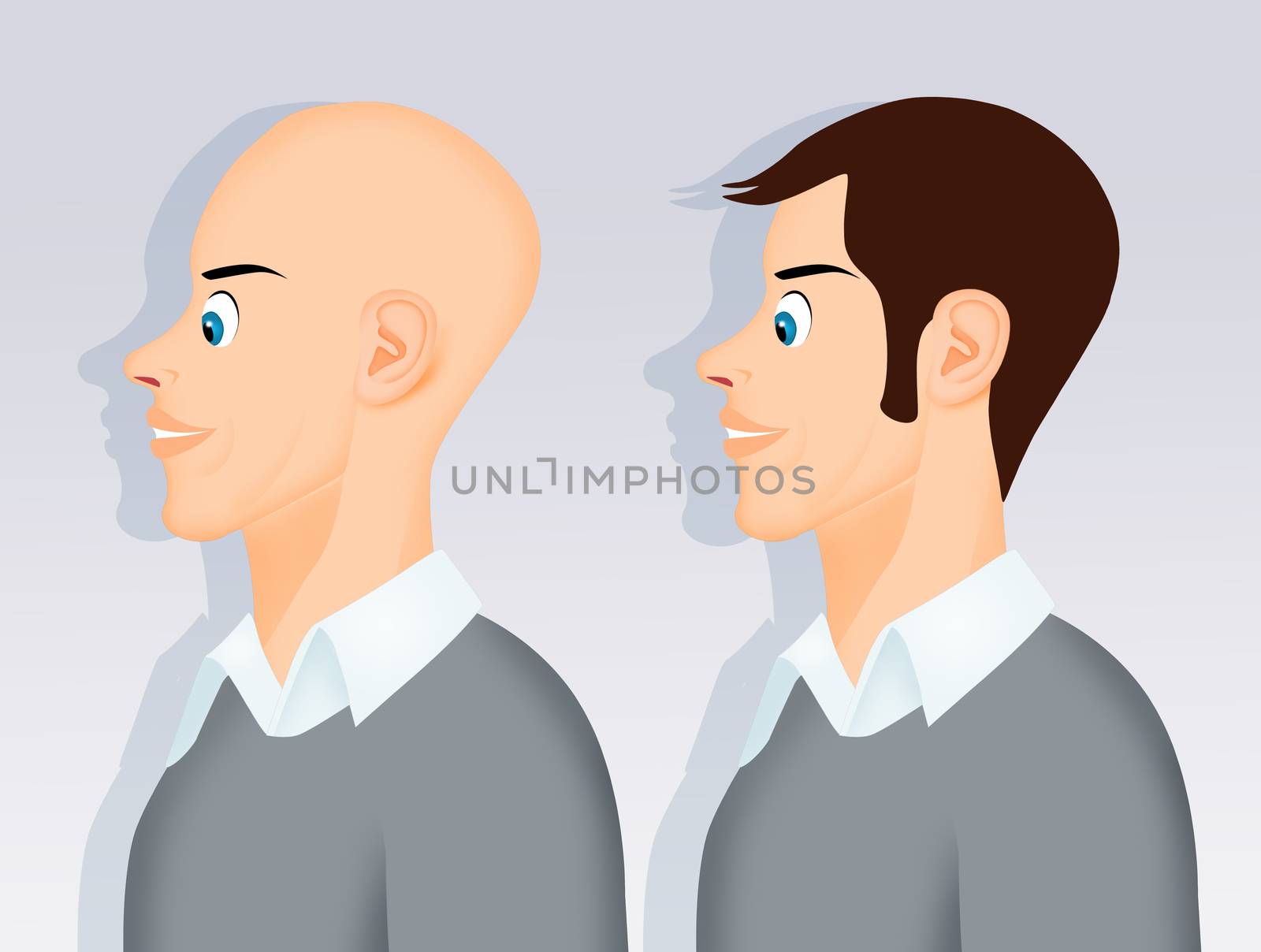 man after hair transplant by adrenalina