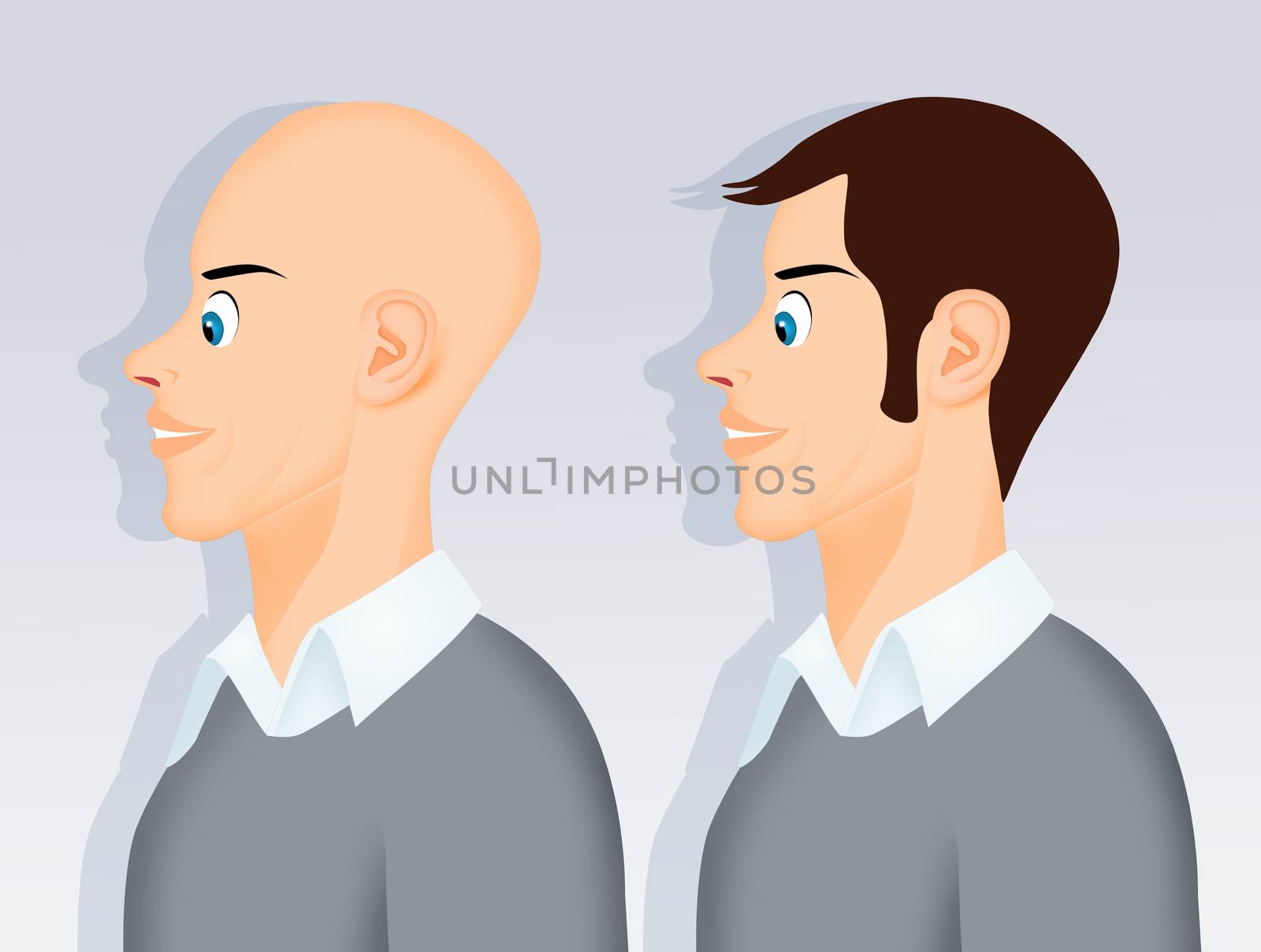 illustration of man after hair transplant