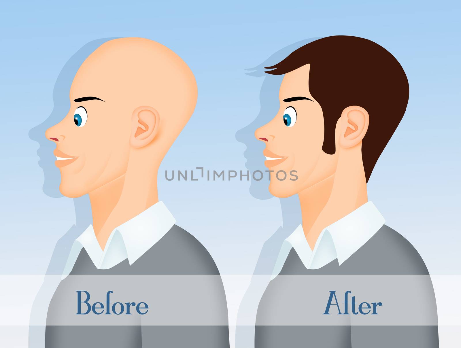 illustration of before and after hair transplantation