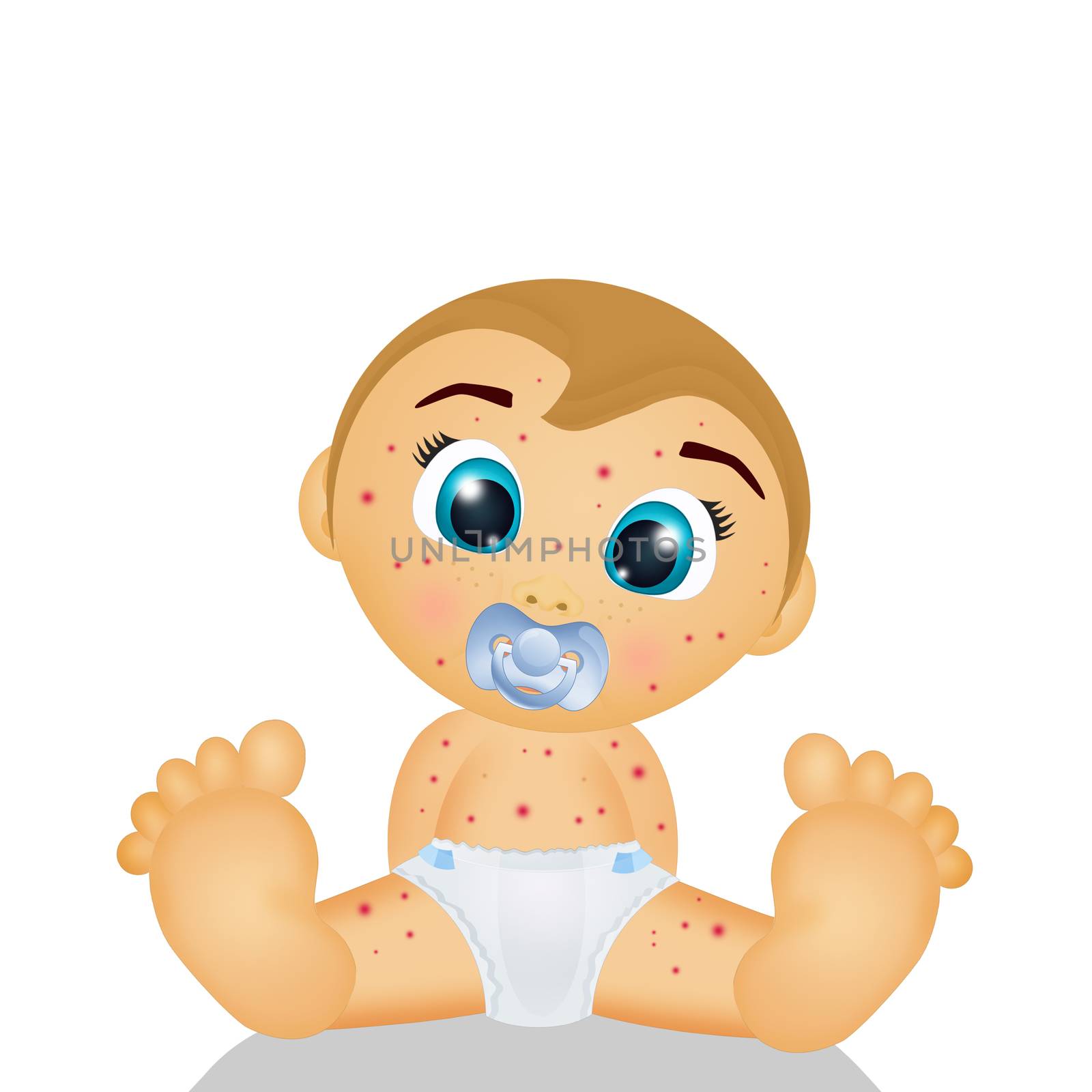 illustration of baby with chicken pox