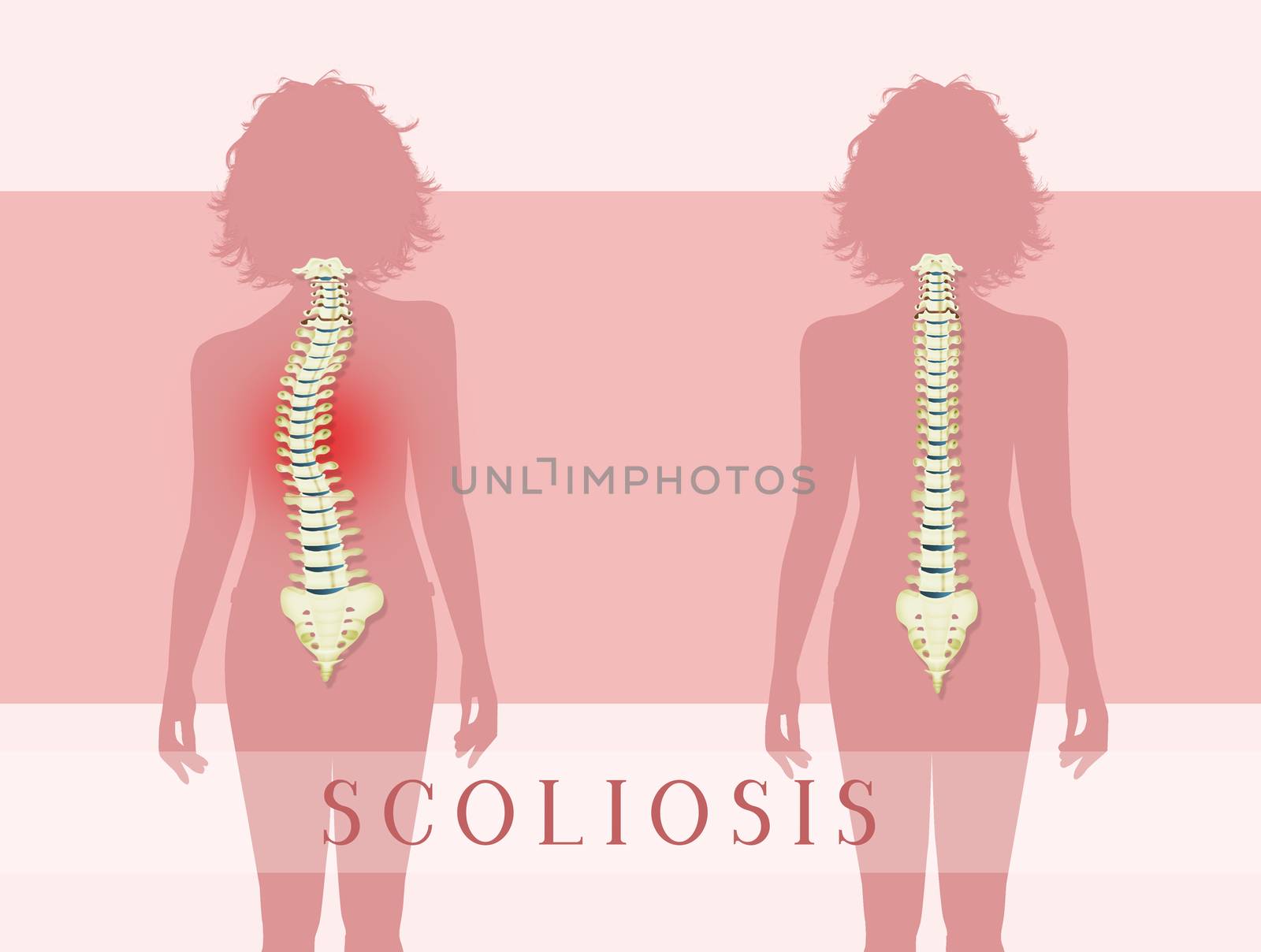 illustration of scoliosis by adrenalina
