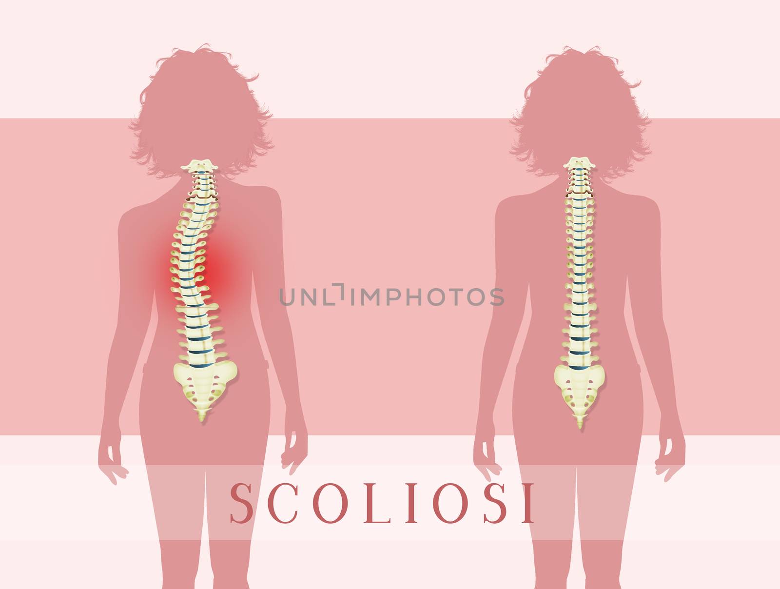 illustration of scoliosis