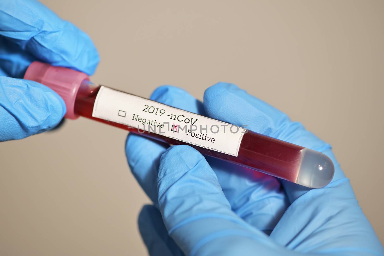 Coronavirus 2019-Ncov With Blood Test by mady70