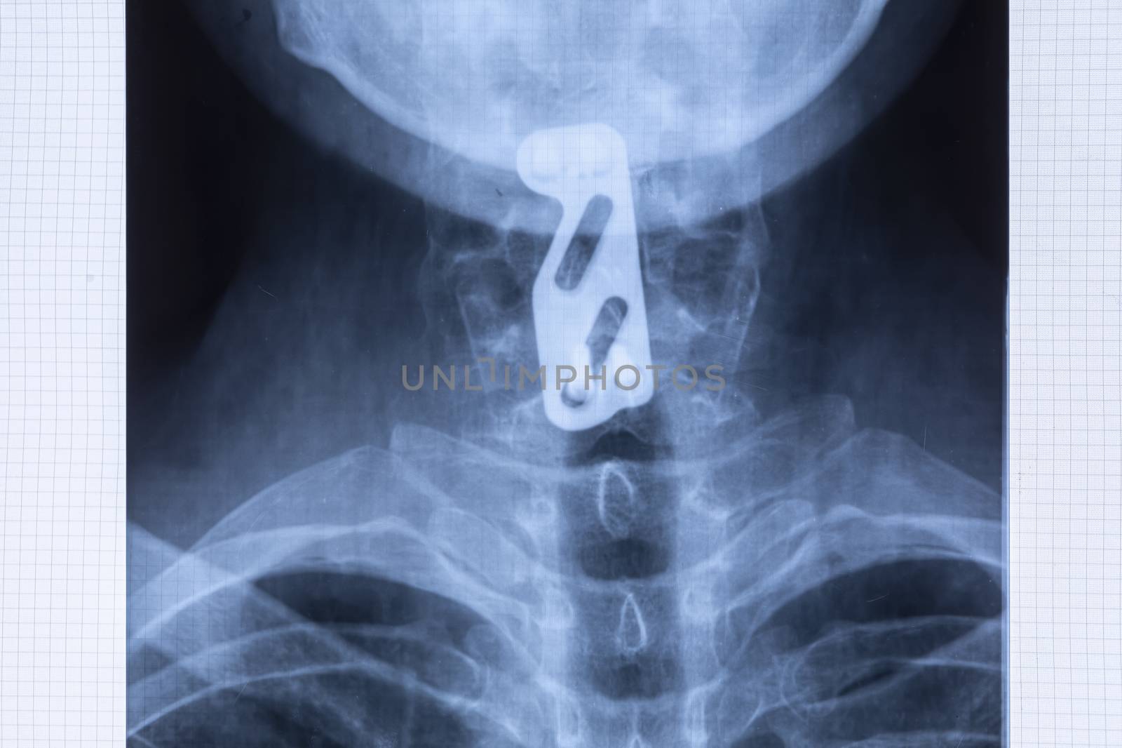 Radiography of titanium plate to support the cervical spine by manaemedia