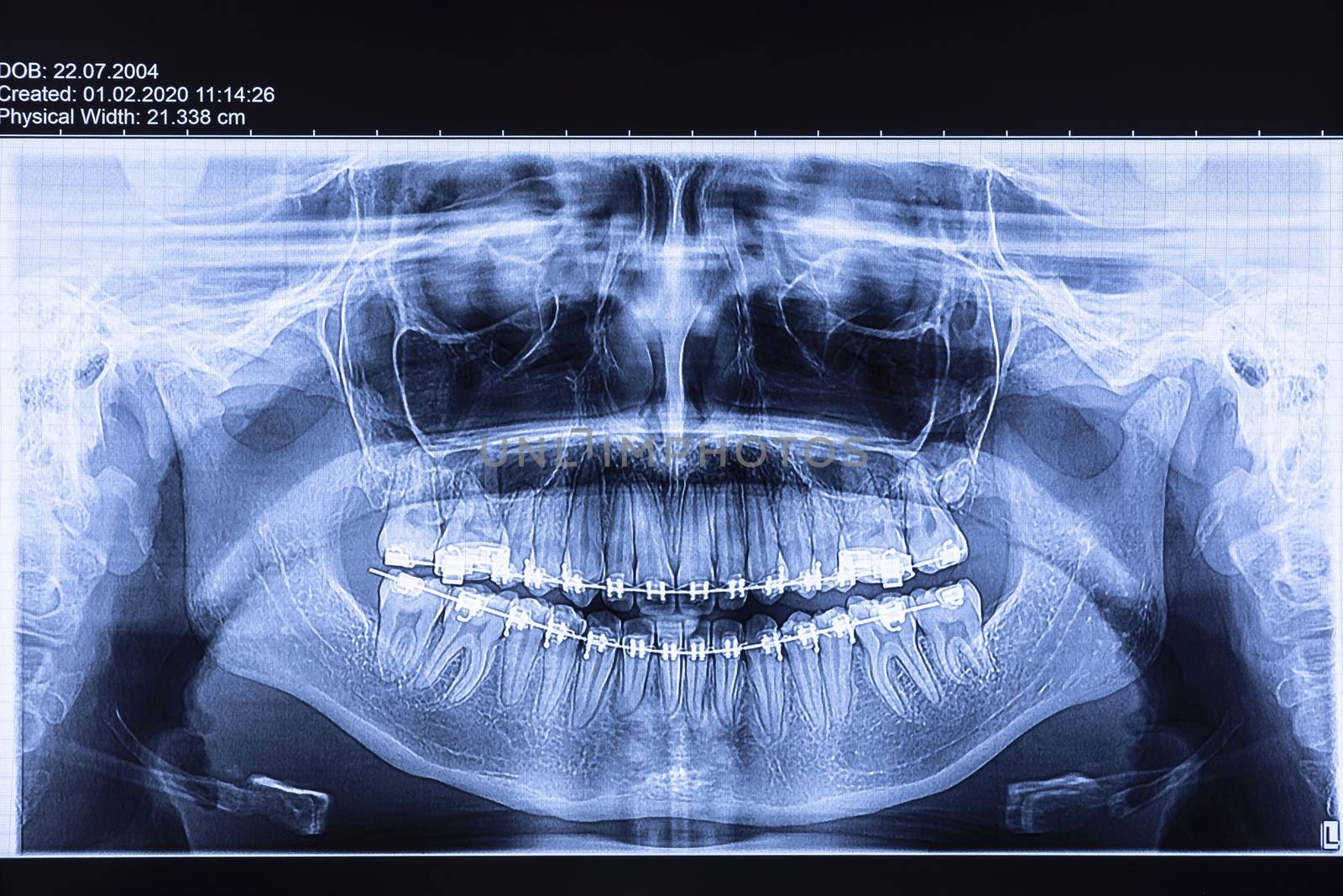 Dental x-ray with braces. Radiography for teeth straightening and dental structures research concept.