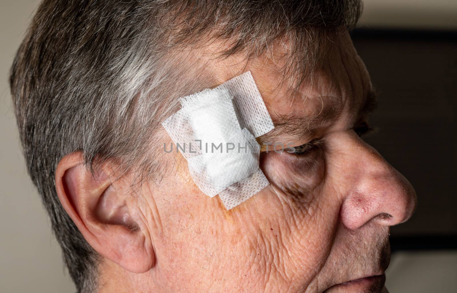 Side view of senior man after MOHS surgery to remove skin cancer with dressings by steheap