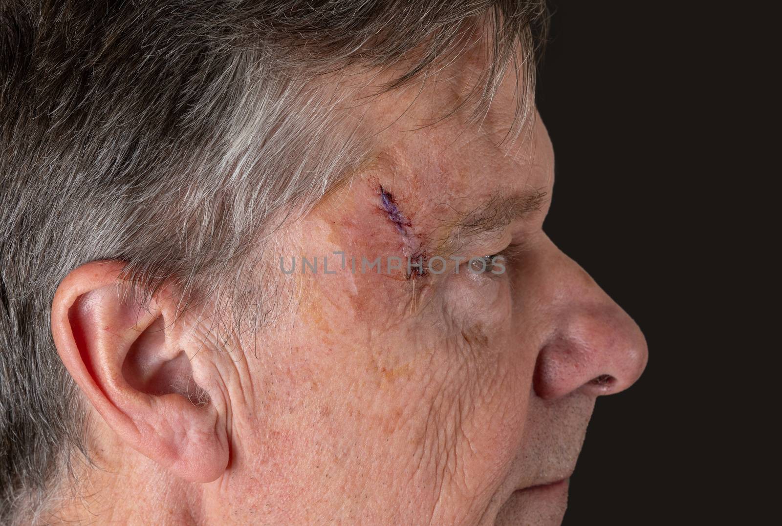 Side view of senior man after MOHS surgery to remove skin cancer stitches in wound by steheap