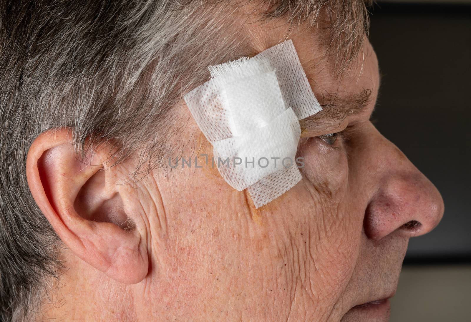 Side view of senior man after MOHS surgery to remove skin cancer with dressings by steheap