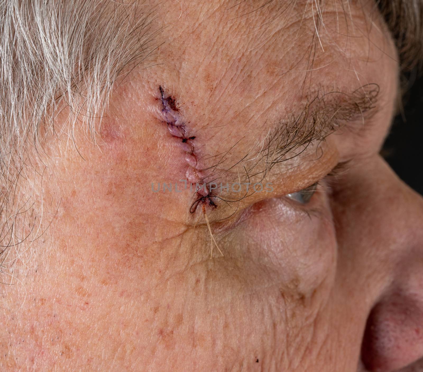 Side view of senior man after MOHS surgery to remove skin cancer stitches in wound by steheap