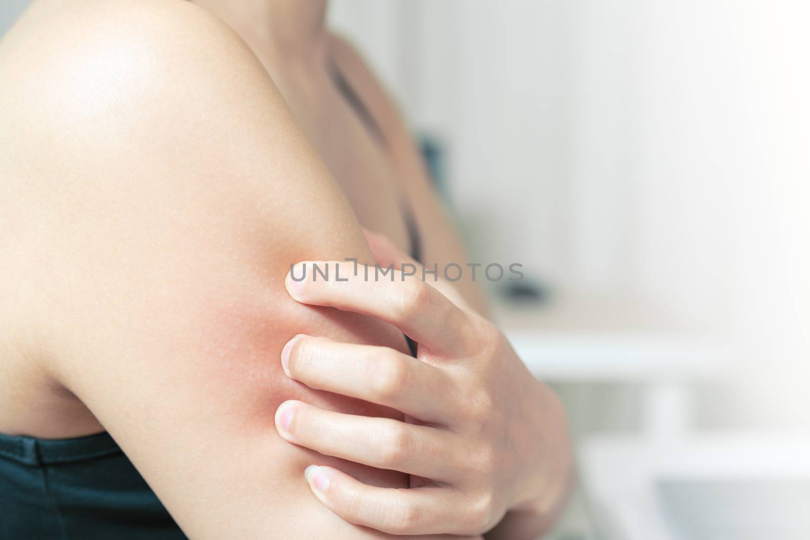 Women hand scratch the itch on arm, healthcare and medicine conc by psodaz