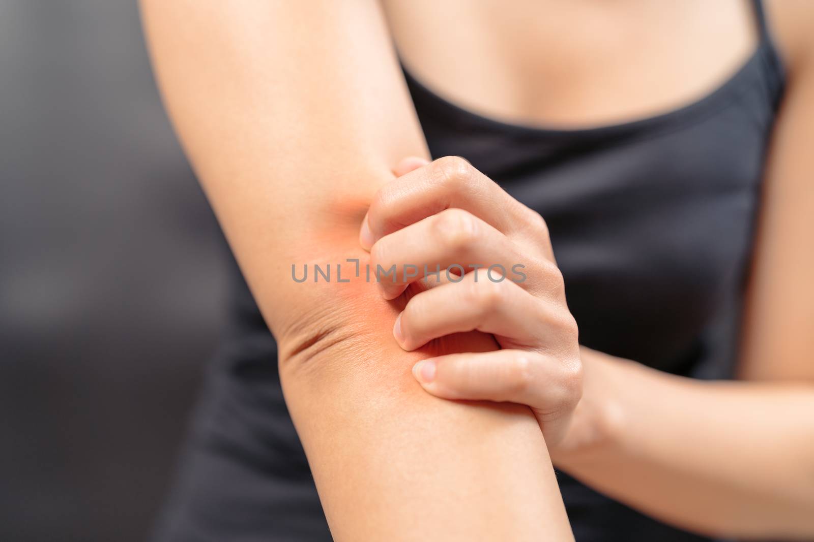 Women hand scratch the itch on arm, healthcare and medicine concept.