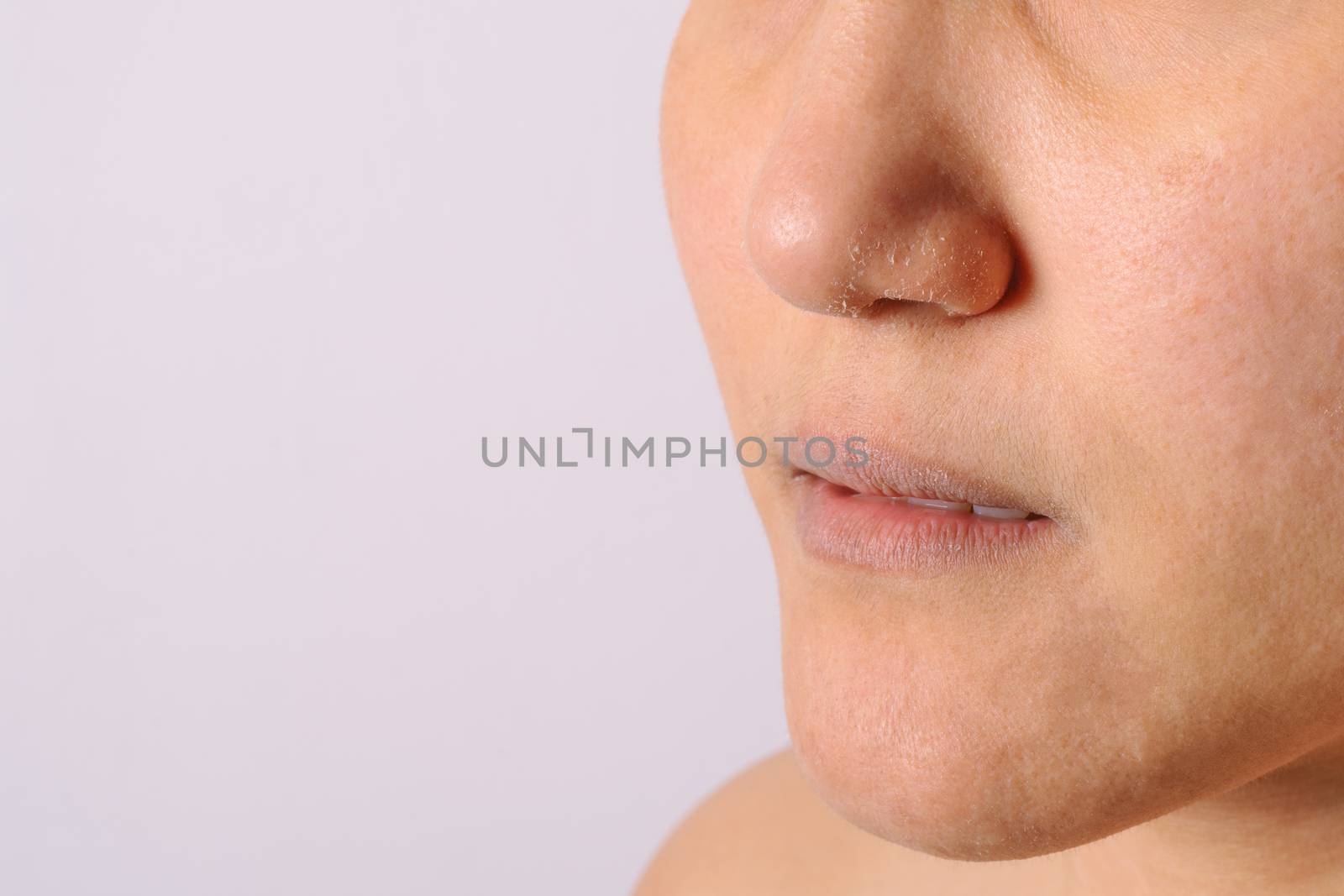 Allergic women have eczema dry nose and lips on winter season closeup.