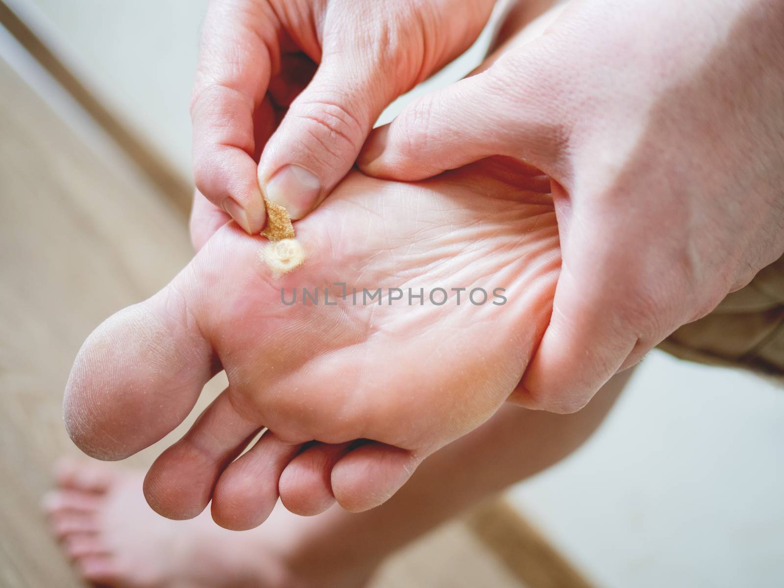 Close up photo of plantar wart on man's foot. Verruca plantaris on the heel is sealed with a salicylic plaster.