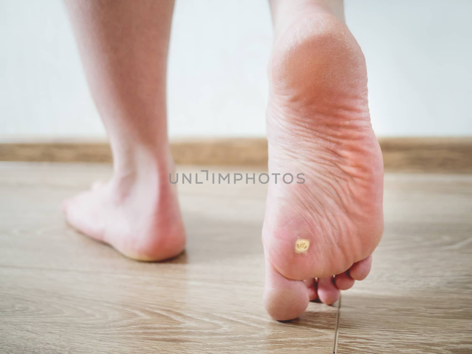 Close up photo of plantar wart on man's foot. Verruca plantaris on the heel.