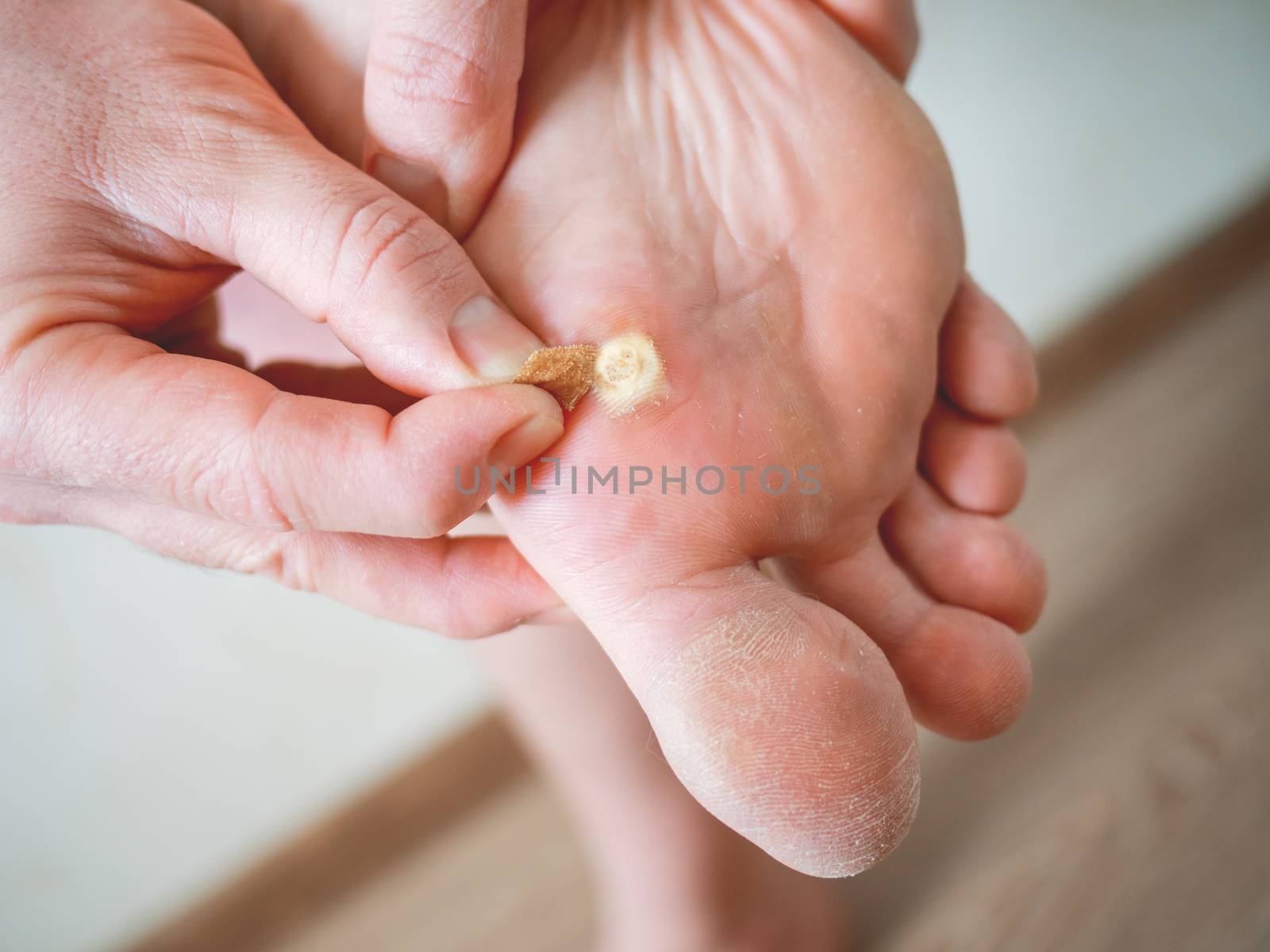 Close up photo of plantar wart on man's foot. Verruca plantaris on the heel is sealed with a salicylic plaster. by aksenovko