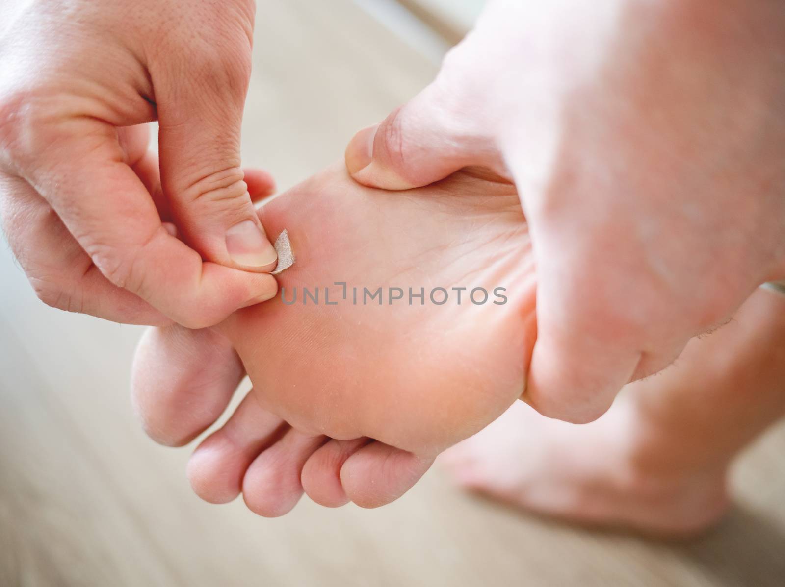 Close up photo of plantar wart on man's foot. Verruca plantaris on the heel is sealed with a salicylic plaster.