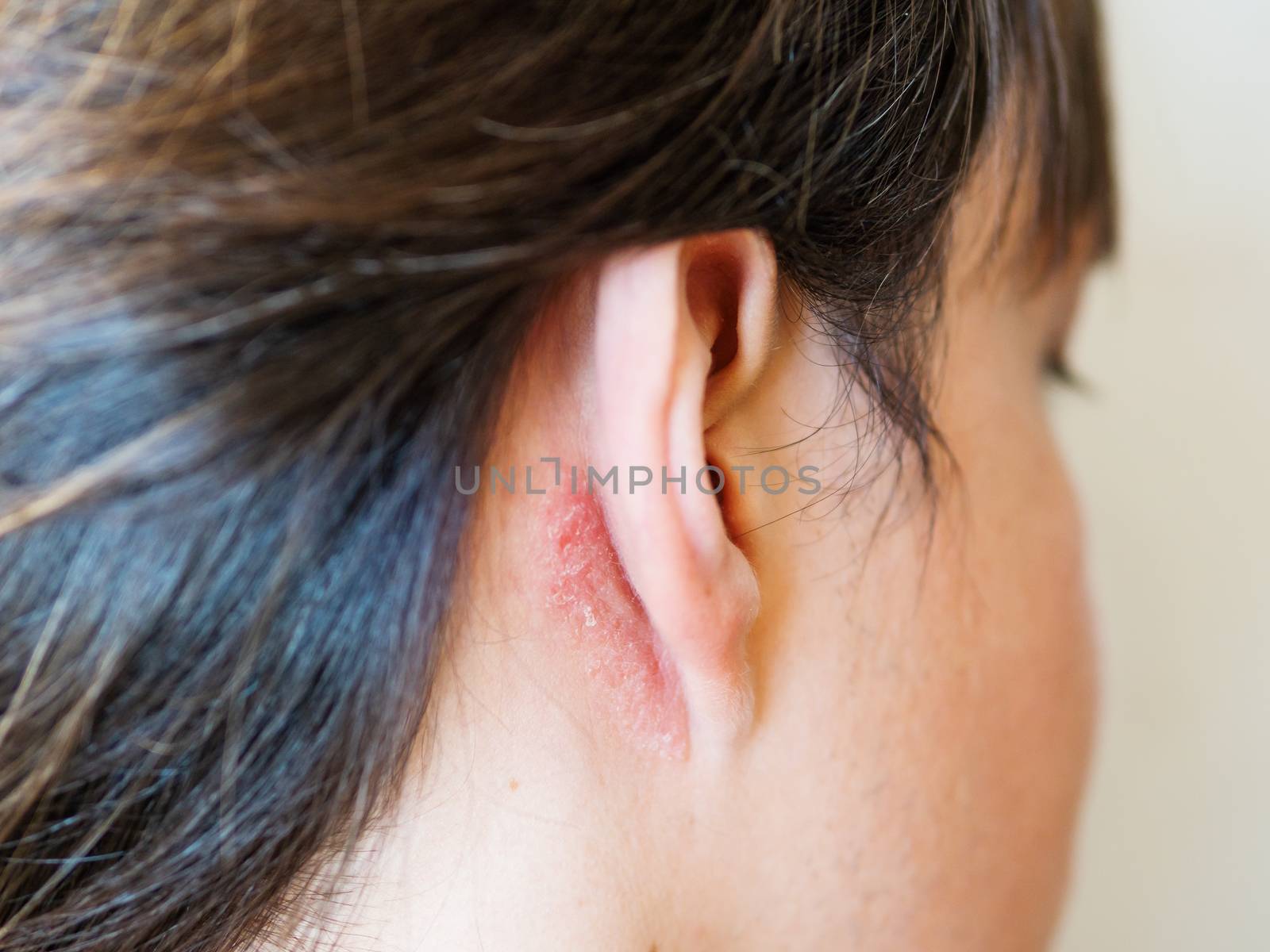 Irritation on the skin behind the ear. Man with flaky skin. Allergy or fungal disease.