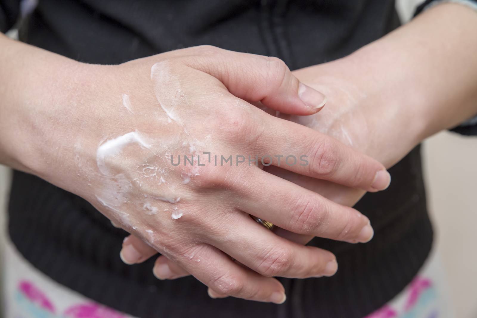Woman putting moisturizer cream on hands with very dry skin