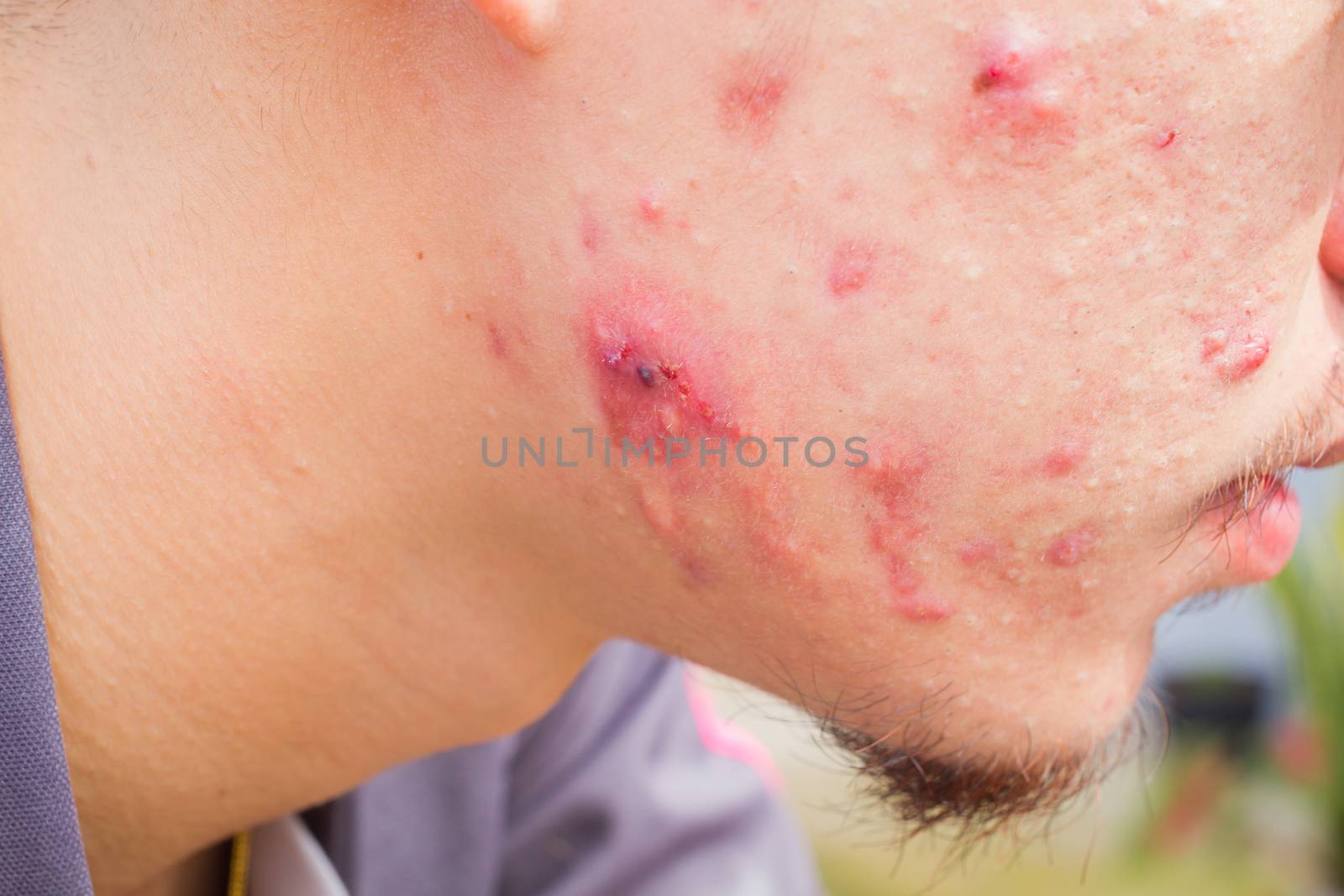 closeup horizontal photo of male cheek with big pimple or acne abcess.