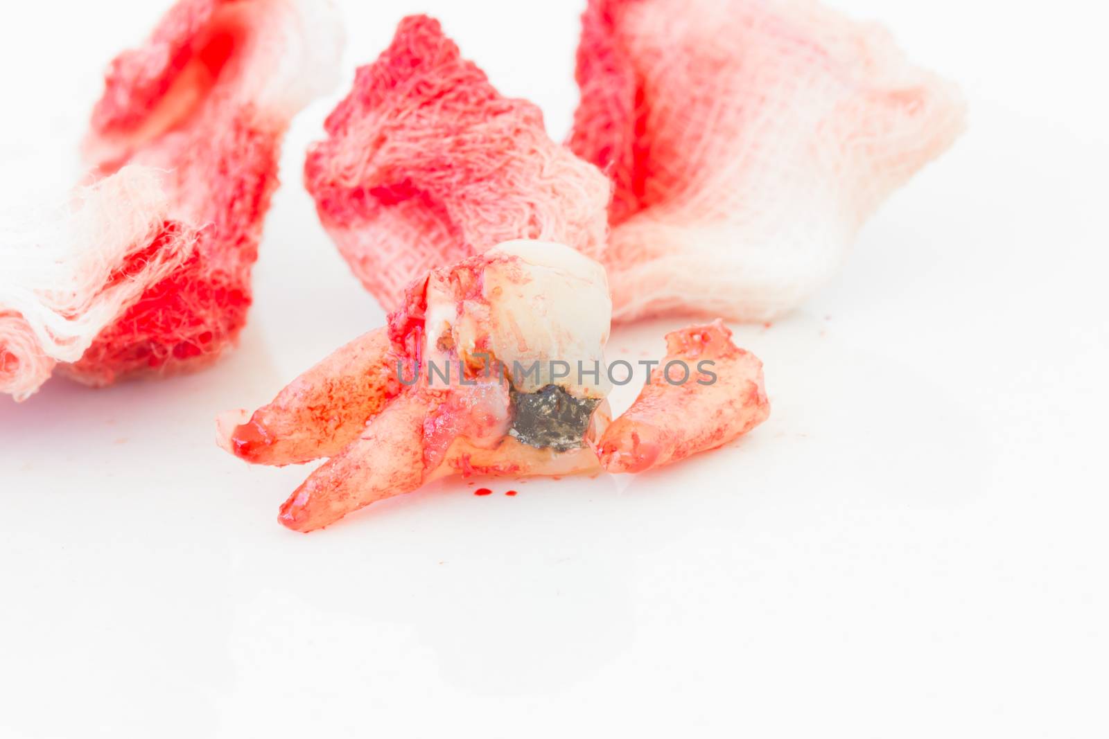 Extraction of decayed tooth with bloody gauze pad on white backg by tidarattj