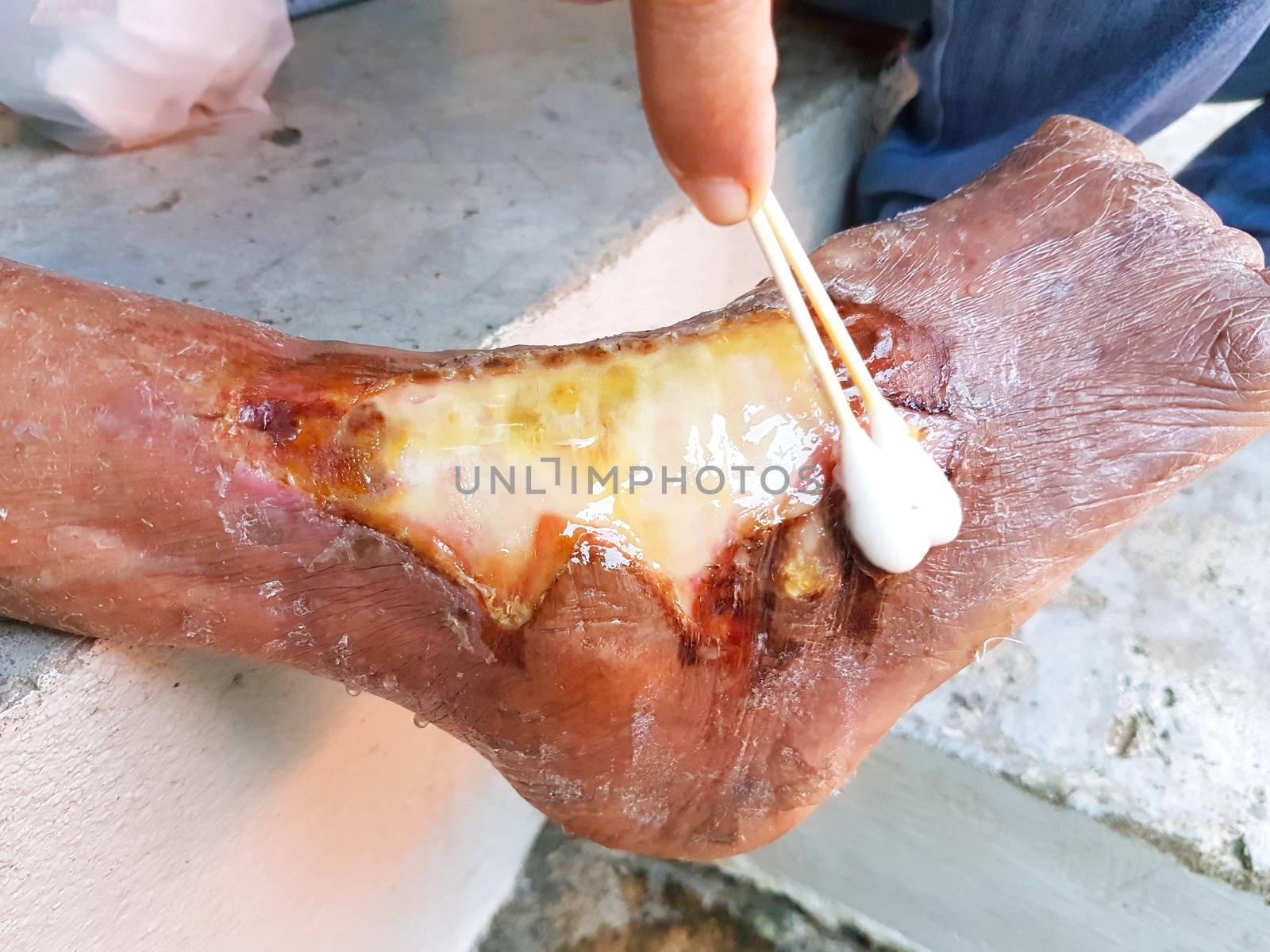 close-up hand of nurse using cotton bud to heal leprosy woman's scalded foot by hot water