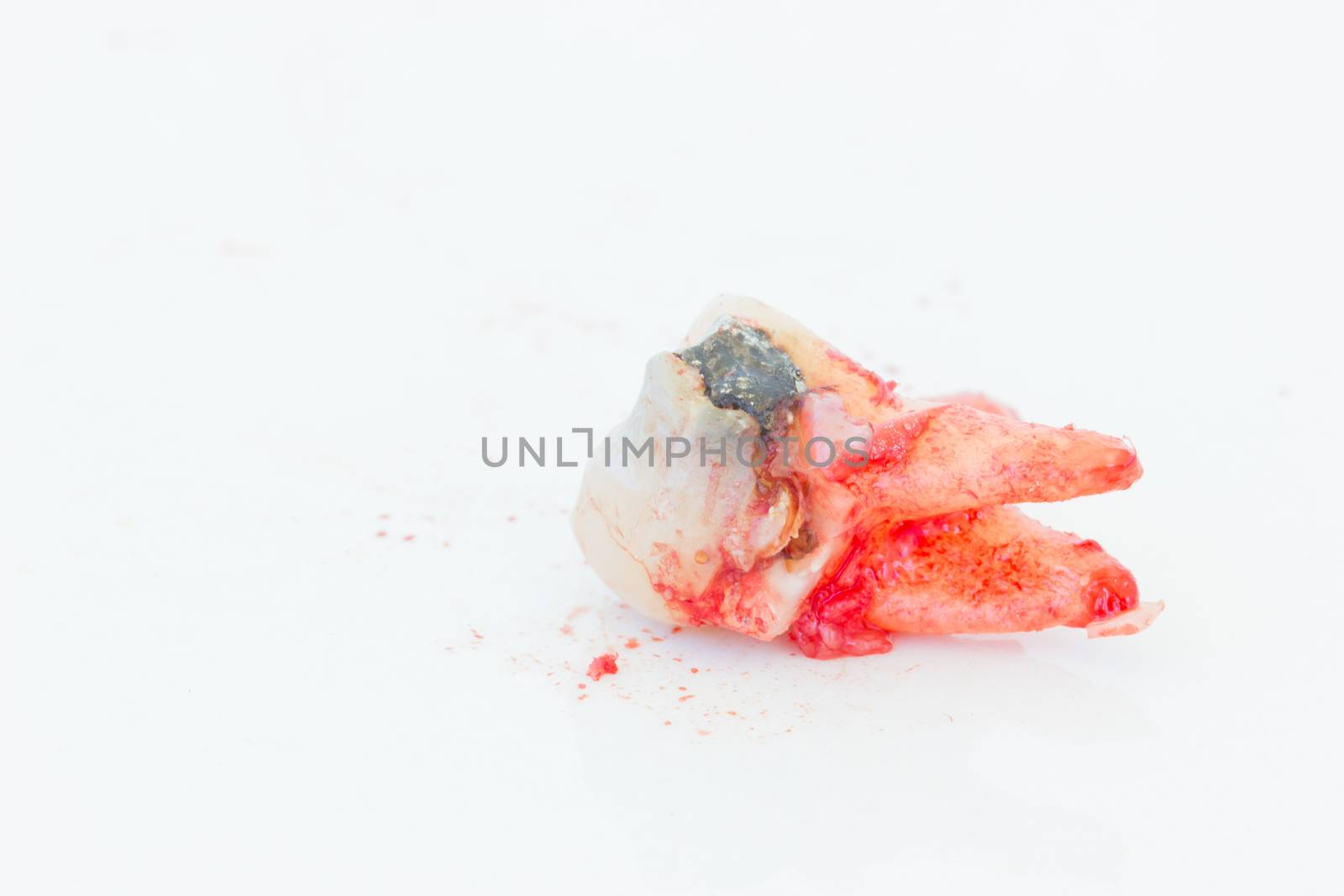 Extraction of decayed tooth on white background.  by tidarattj
