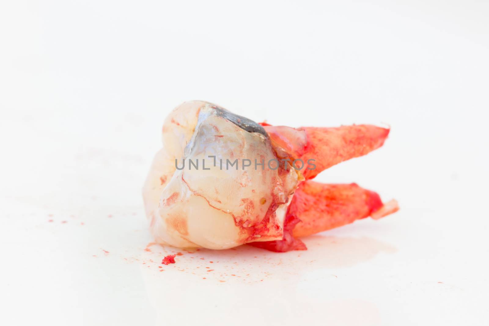 Extraction of decayed tooth on white background.