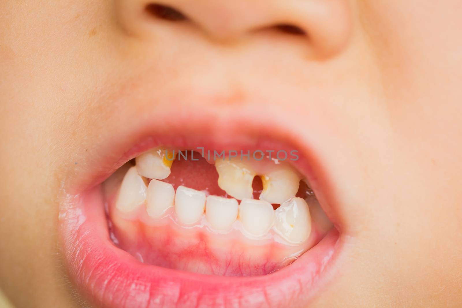 close-up selective focus broken front teeth of asian little girl, dental health concept.