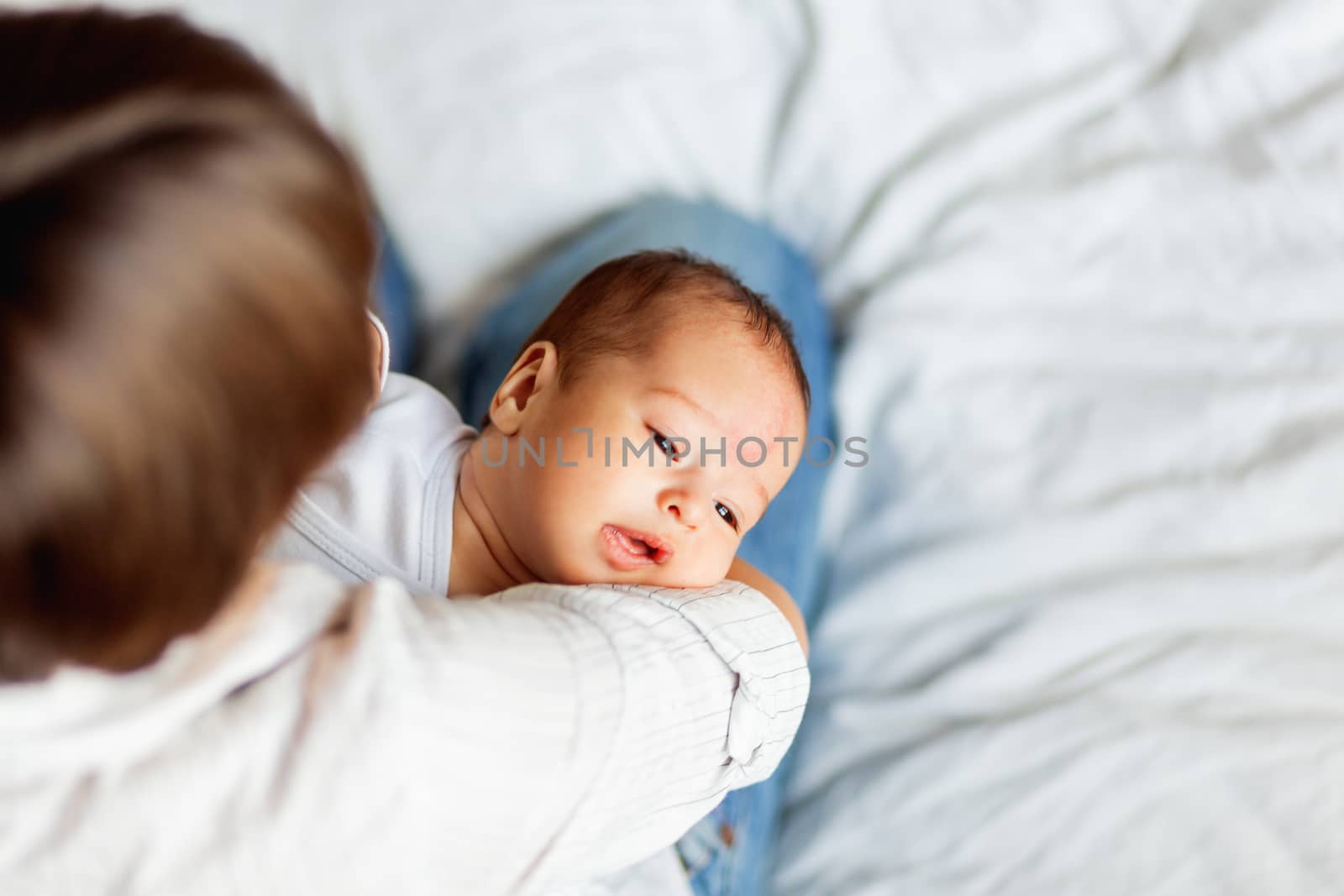 Woman holding her child. Mother comforts her little son or daughter. Baby with a big birthmark on his or her forehead.