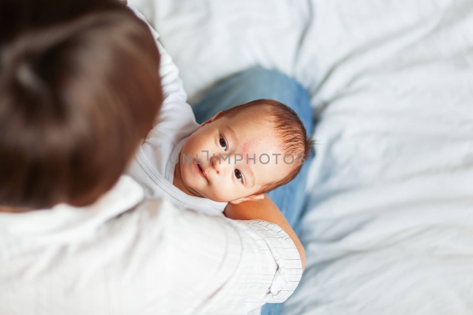 Woman holding her child. Mother comforts her little son or daughter. Baby with a big birthmark on his or her forehead.