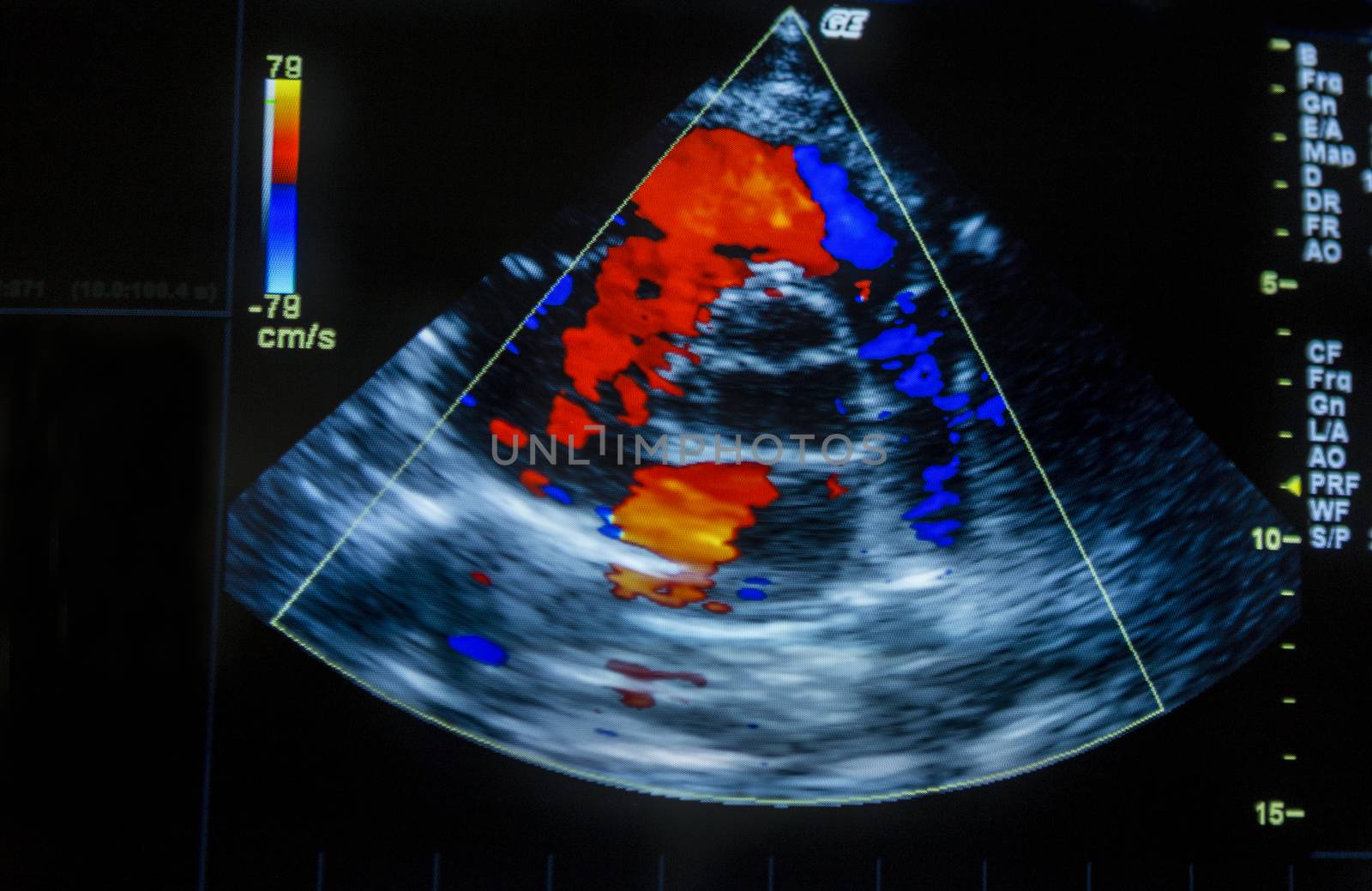 Heart ultrasound image on a computer screen.