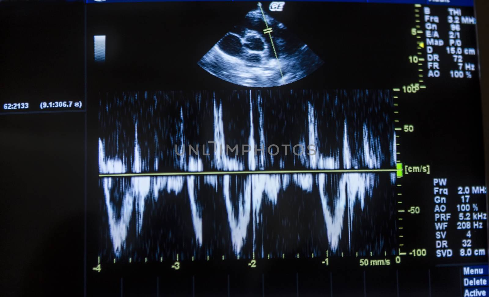 Heart ultrasound image on computer screen and cardiogram. by ververidis