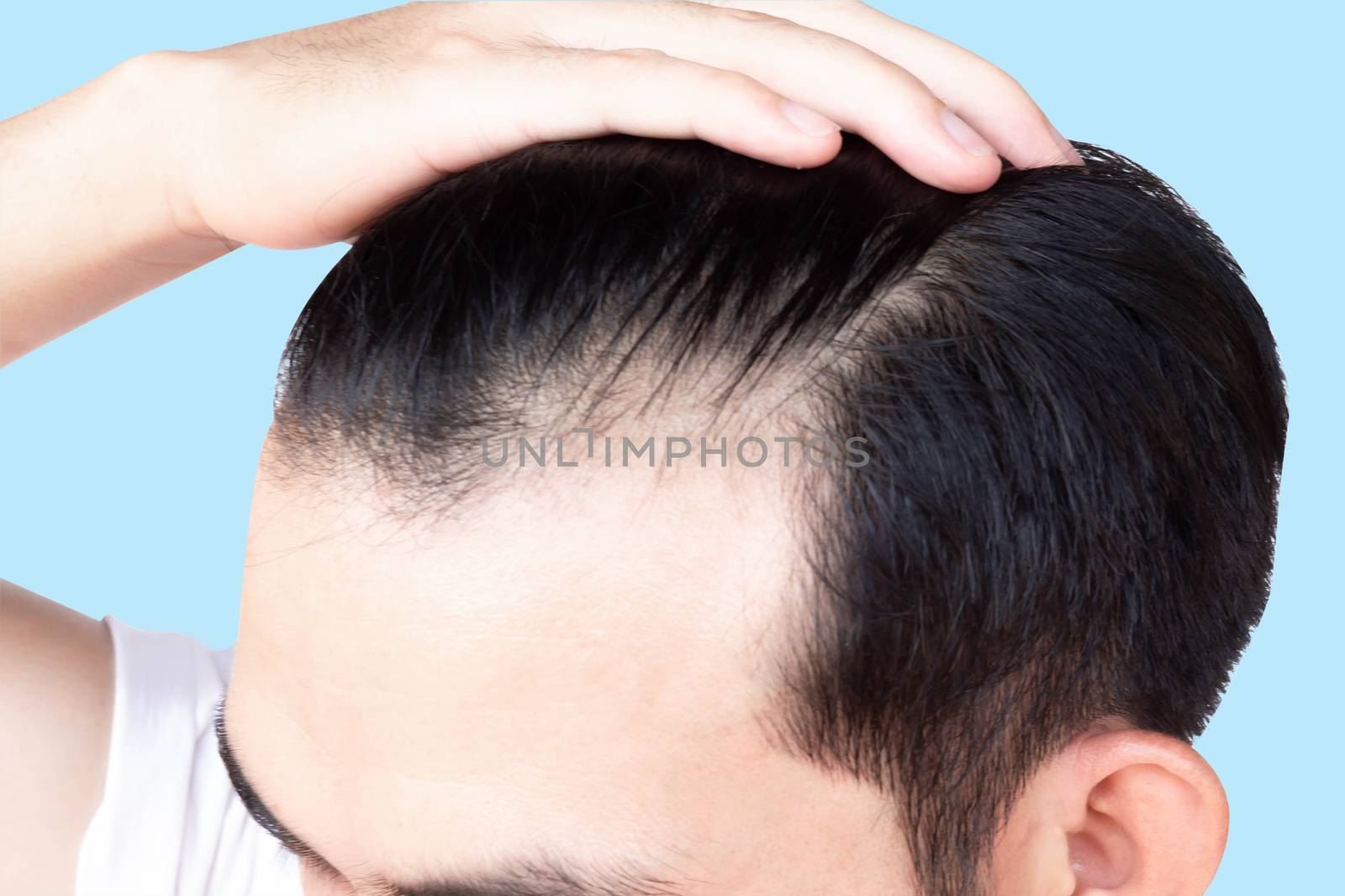 Young man serious hair loss problem for health care medical and shampoo product concept, selective focus