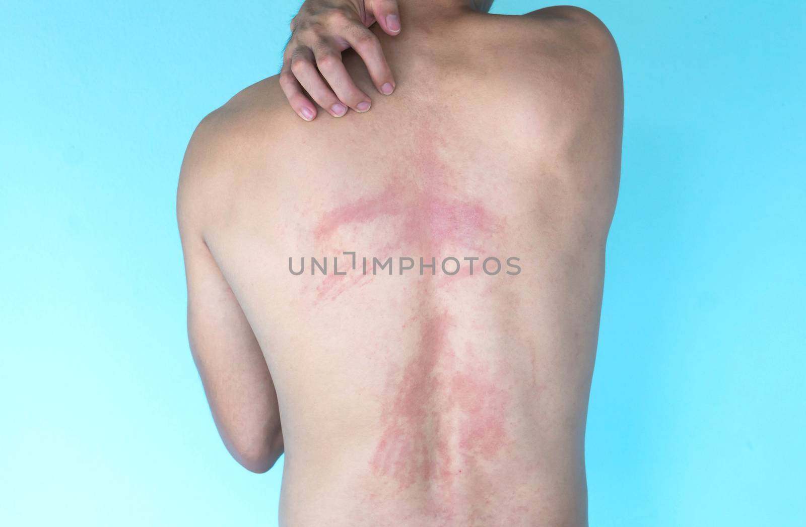 Closeup allergy rash on back skin, health care and medical conce by pt.pongsak@gmail.com