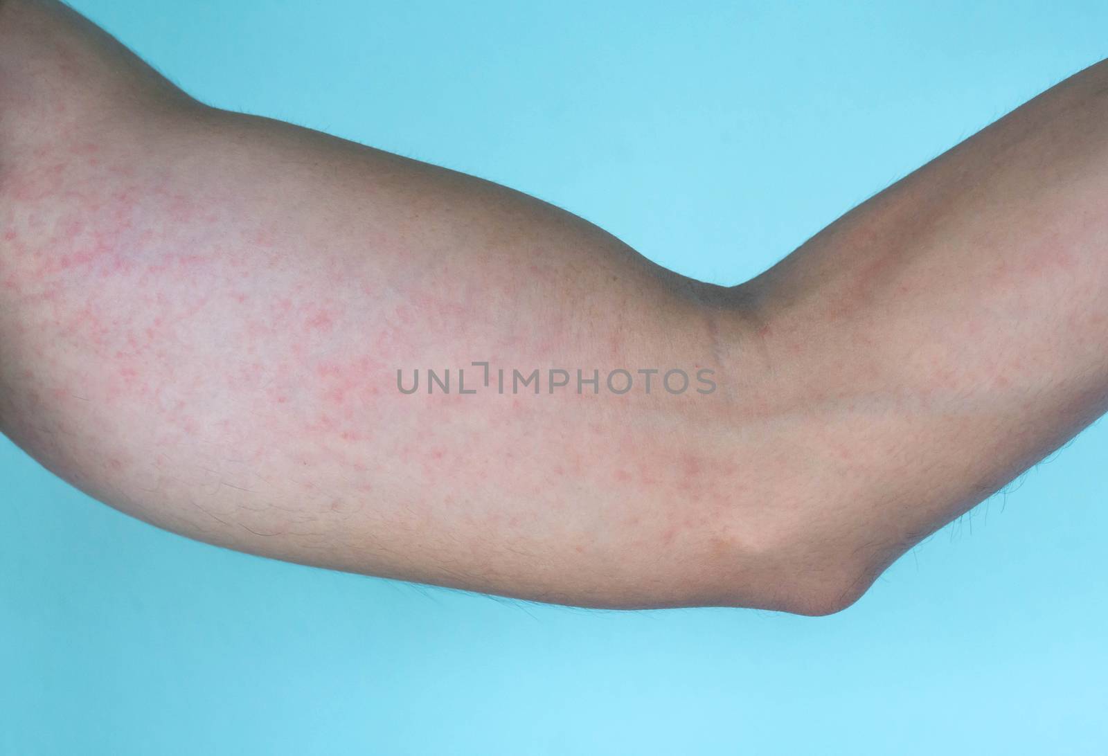 Closeup allergy rash on arm skin, health care and medical concep by pt.pongsak@gmail.com