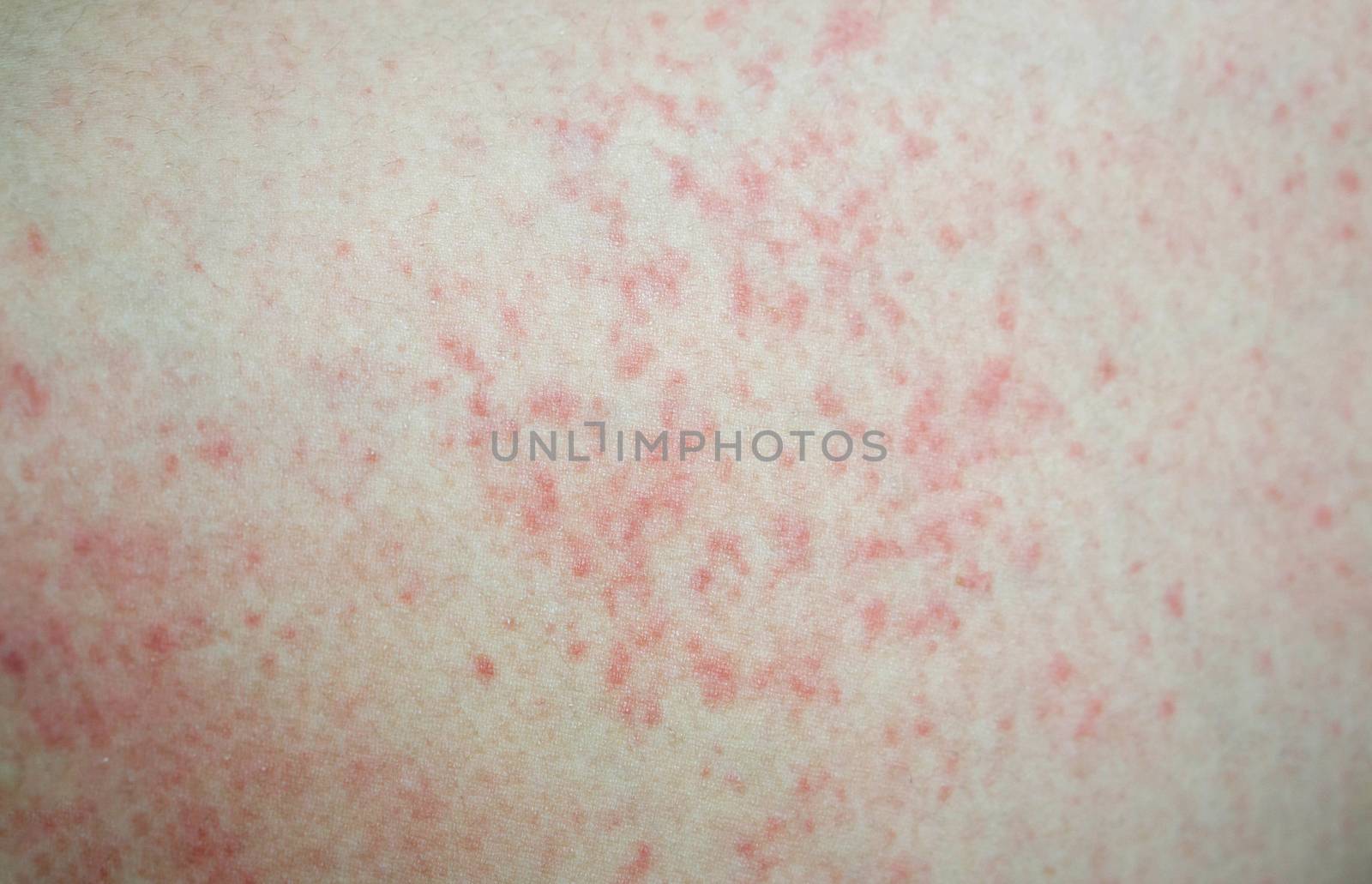 Closeup allergy rash on skin, health care and medical concept by pt.pongsak@gmail.com