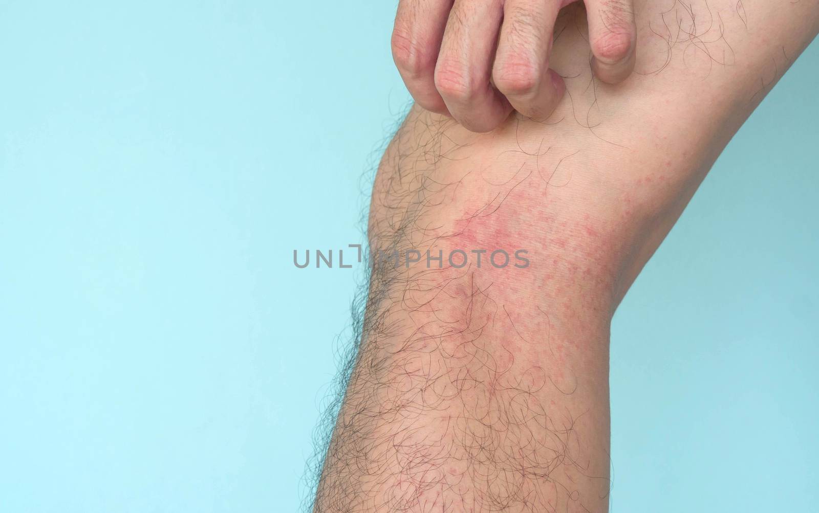 Closeup man hand scratching allergy rash on leg skin, health care and medical concept