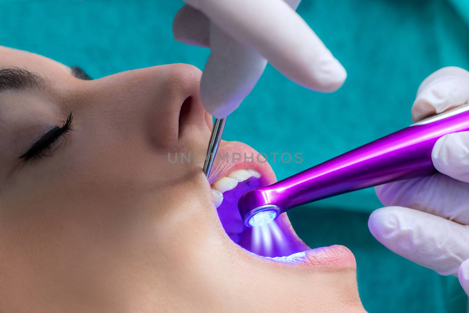 Macro close up of hand working on female teeth with blue led curing light.