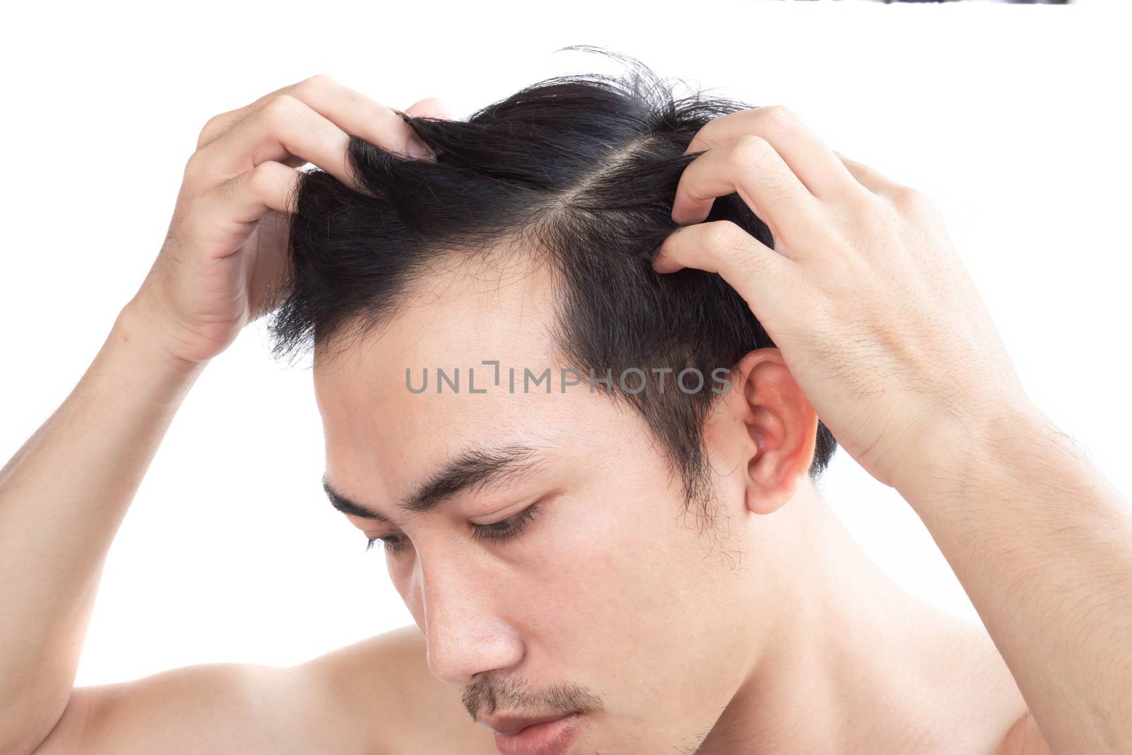 Young man serious hair loss problem for health care medical and  by pt.pongsak@gmail.com