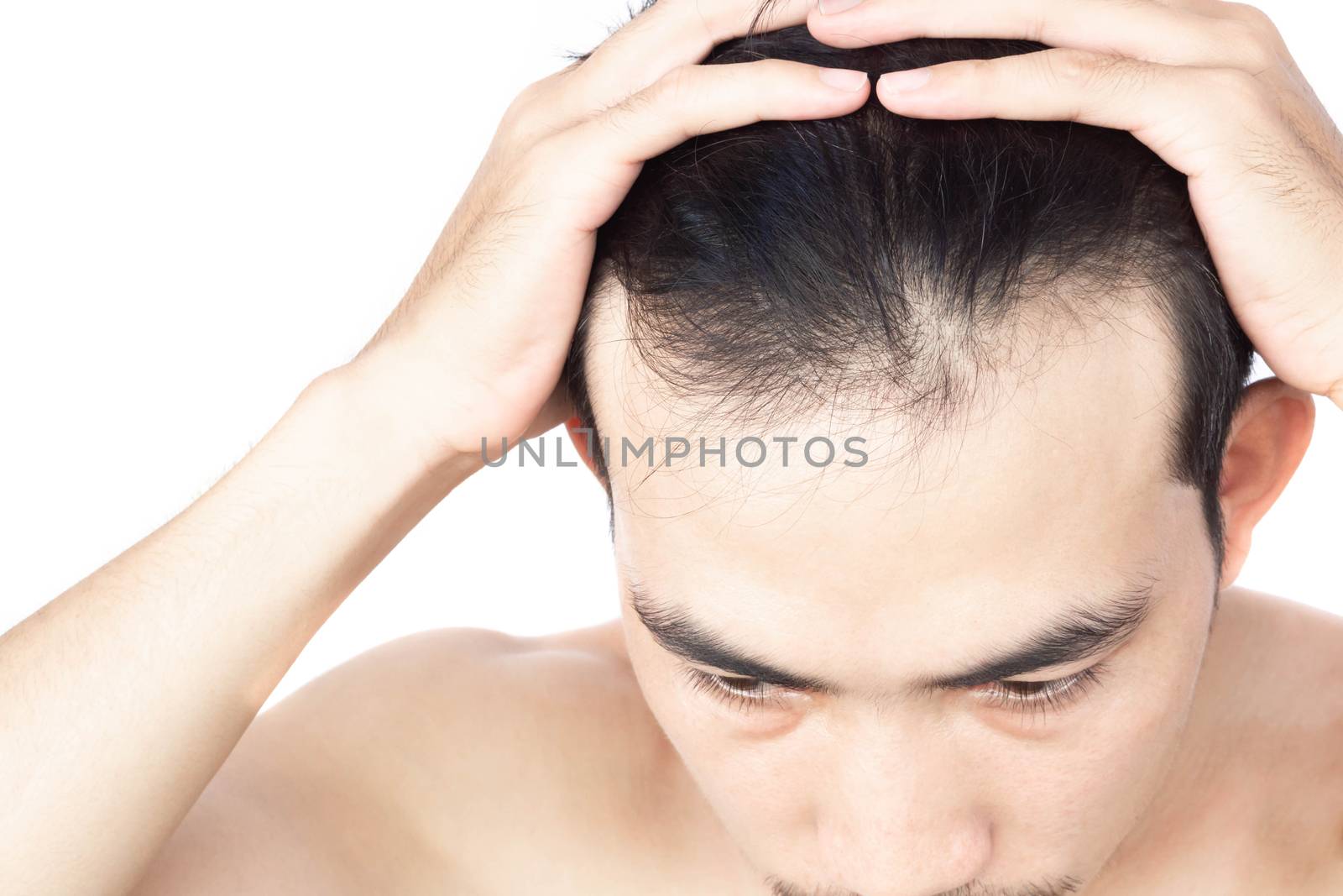 Young man serious hair loss problem for health care medical and  by pt.pongsak@gmail.com