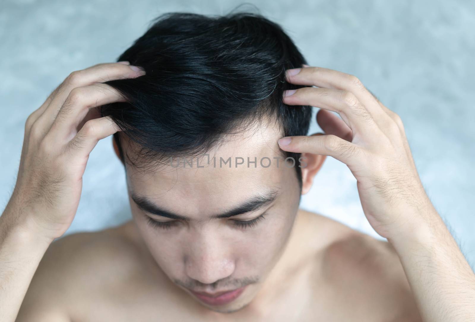 Young man serious hair loss problem for health care medical and shampoo product concept, selective focus