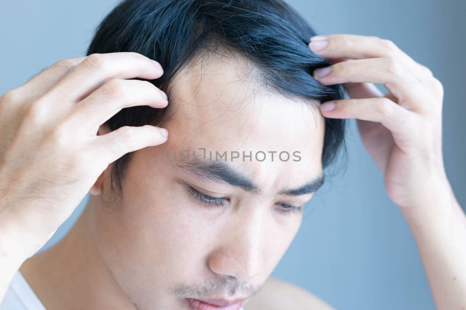 Young man serious hair loss problem for health care medical and shampoo product concept, selective focus