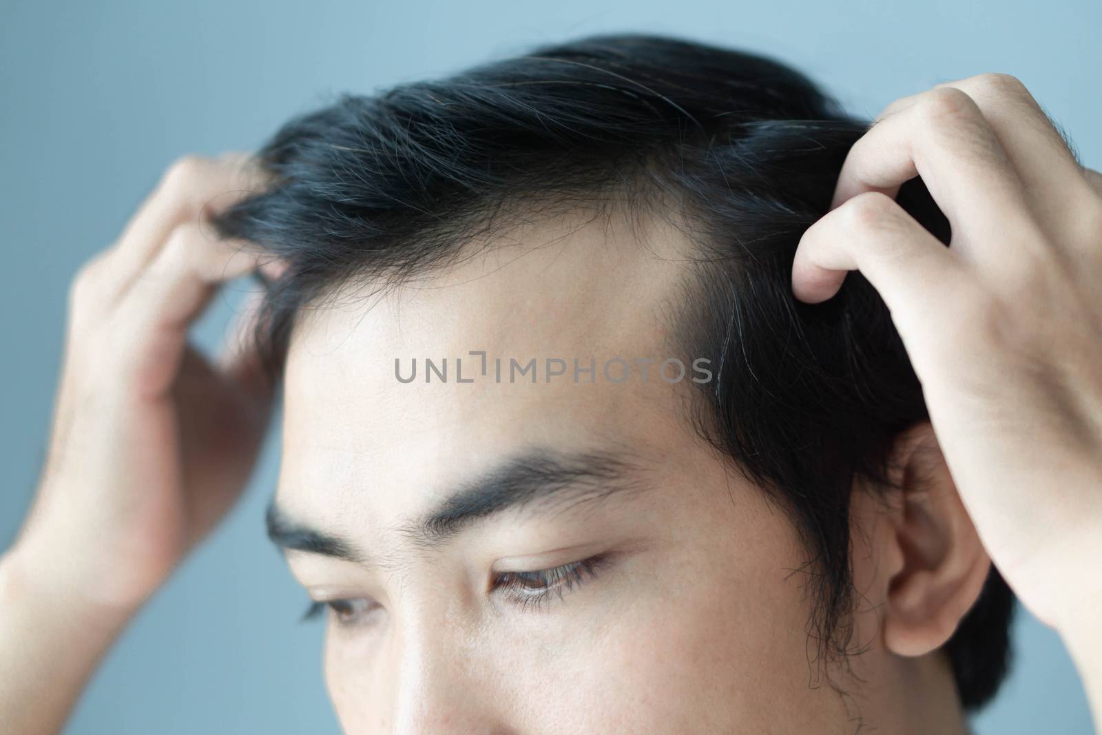 Young man serious hair loss problem for health care medical and shampoo product concept, selective focus