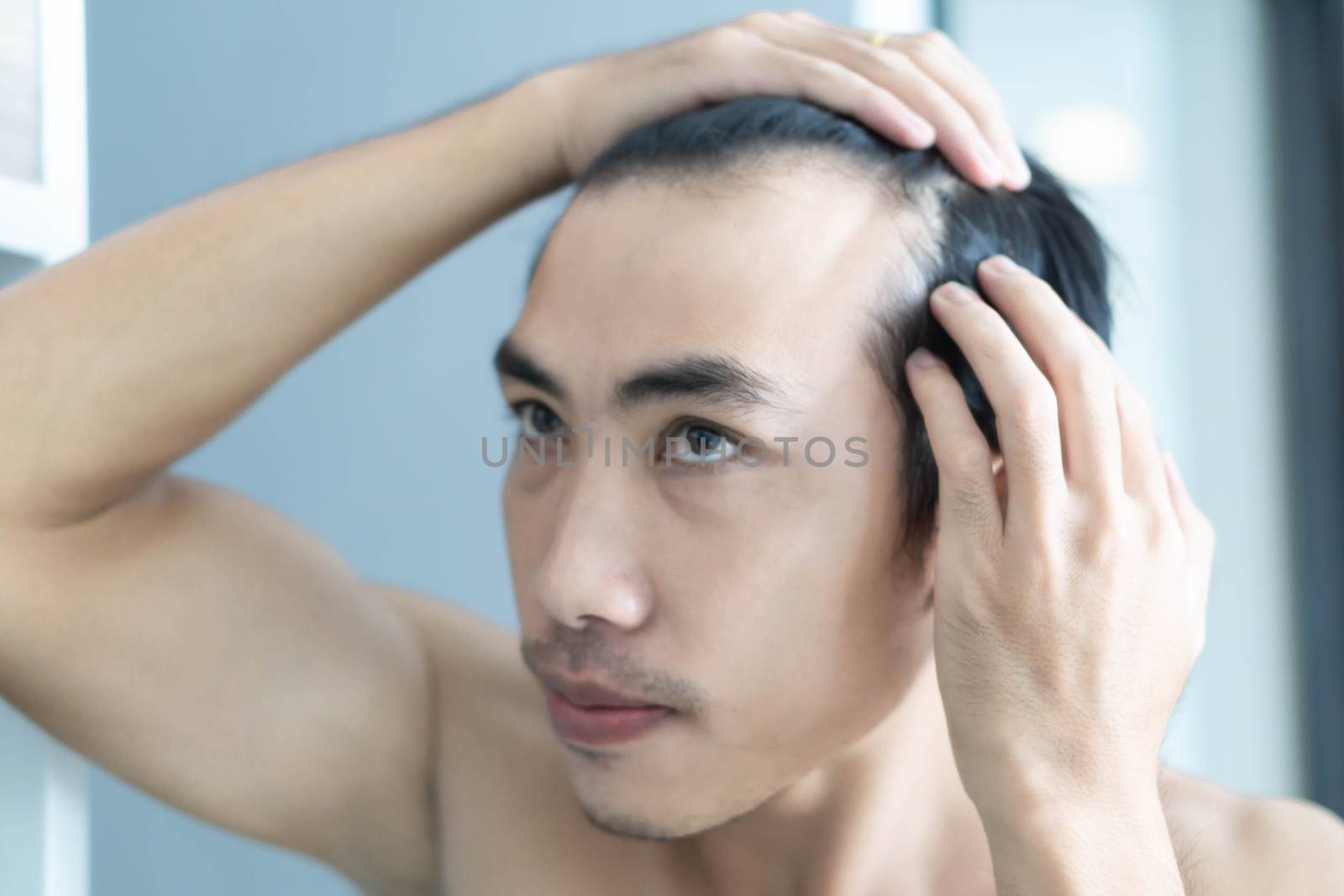 Young man serious hair loss problem for health care medical and  by pt.pongsak@gmail.com