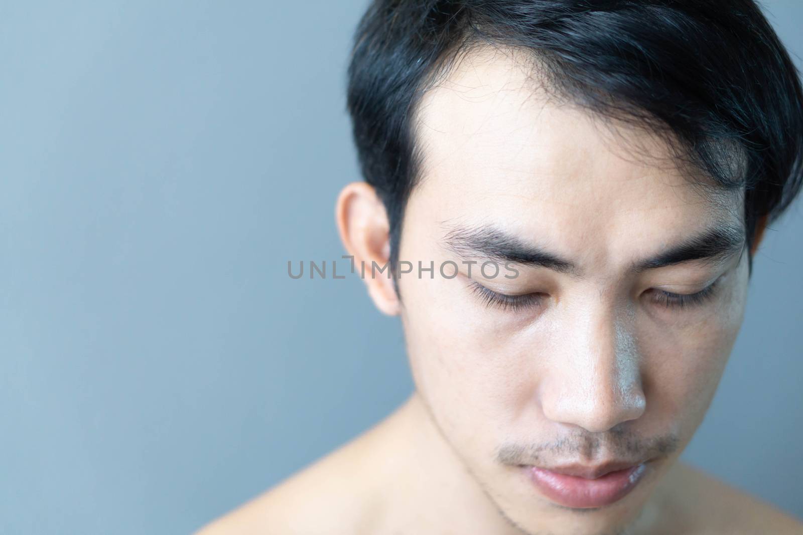 Young man serious hair loss problem for health care medical and shampoo product concept, selective focus