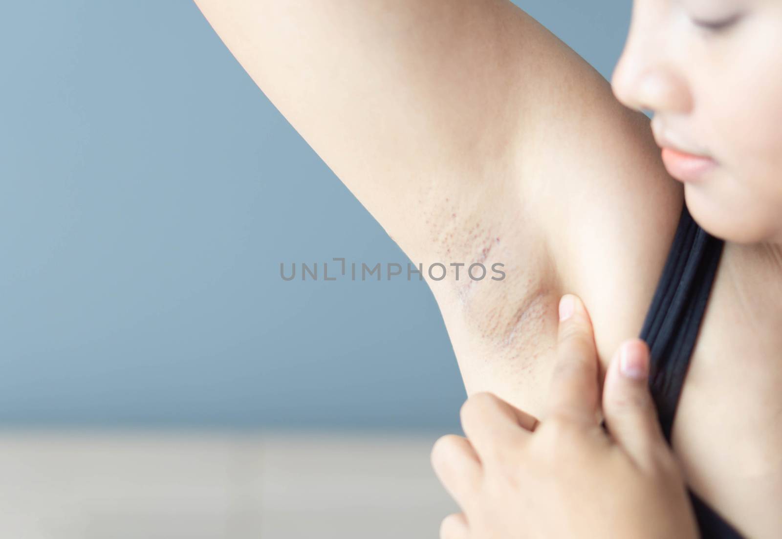 Women problem black armpit lying on white bed background for skin care and beauty concept, selective focus