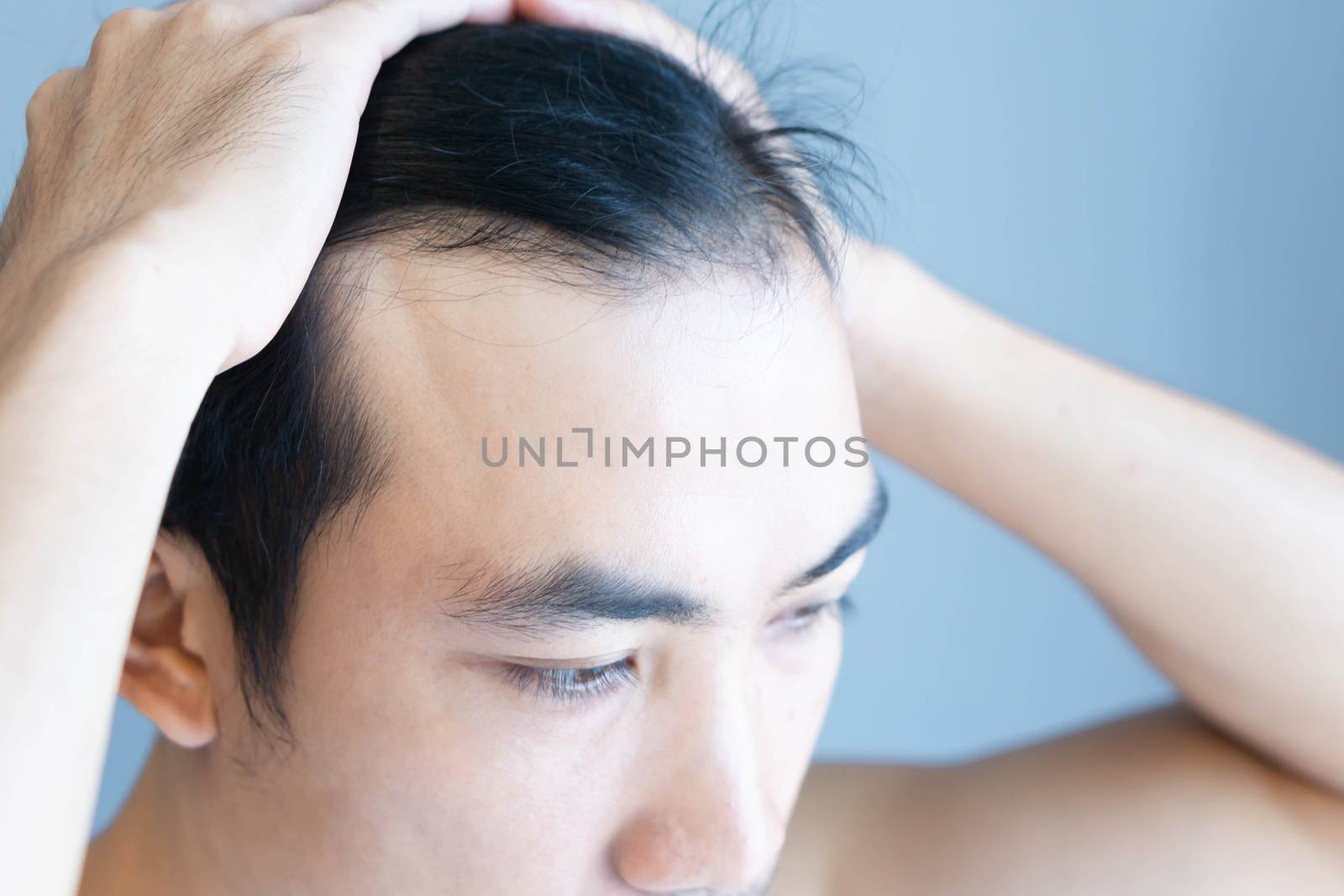 Young man serious hair loss problem for health care medical and shampoo product concept, selective focus