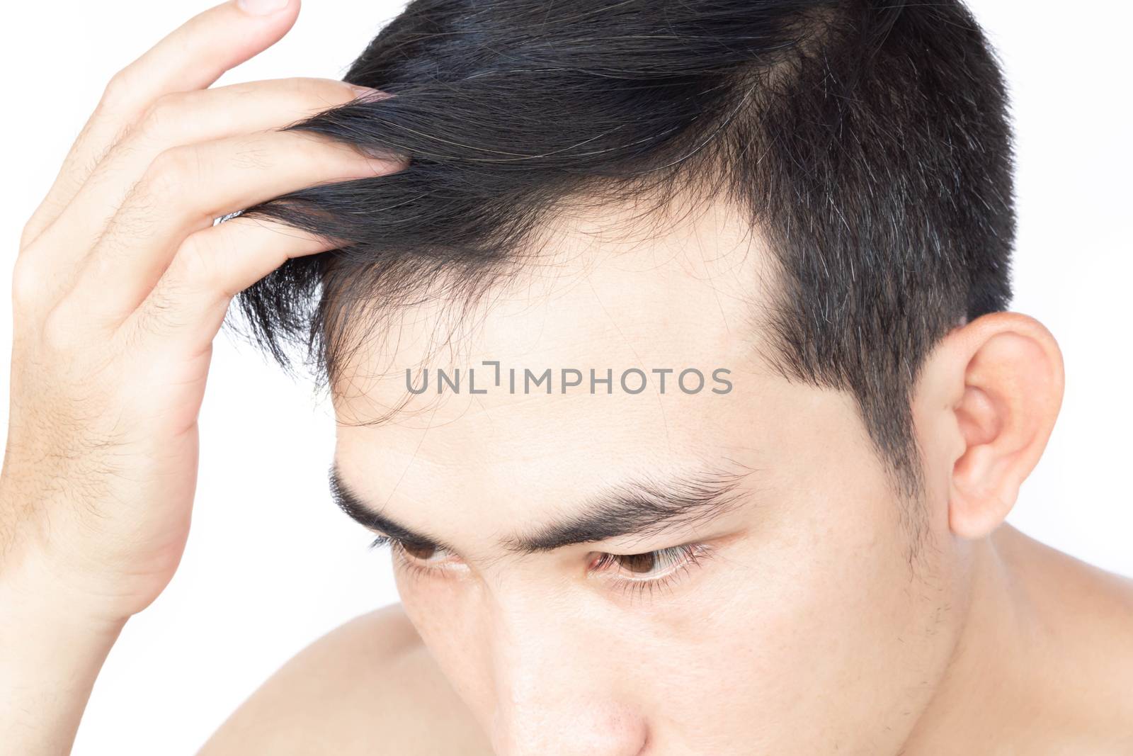 Young man serious hair loss problem for health care medical and shampoo product concept, selective focus